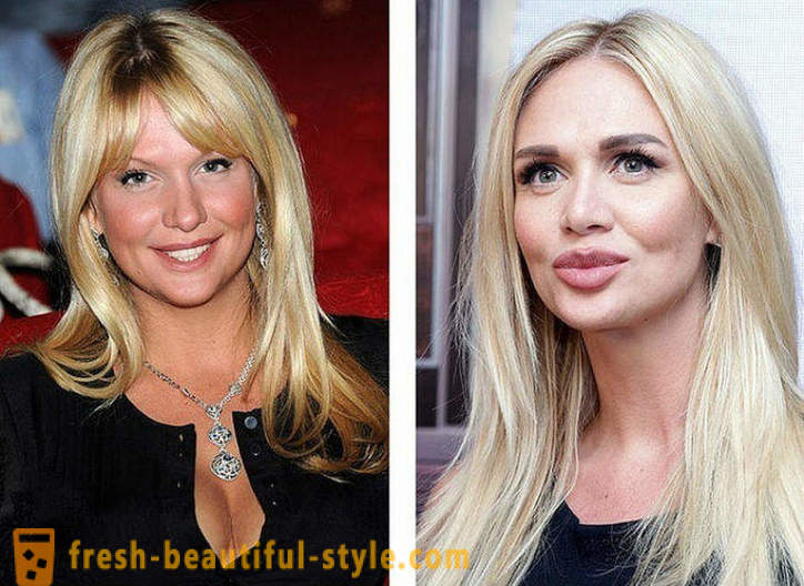 10 ρωσικά ομορφιές πριν και μετά την πλαστική