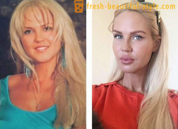 10 ρωσικά ομορφιές πριν και μετά την πλαστική