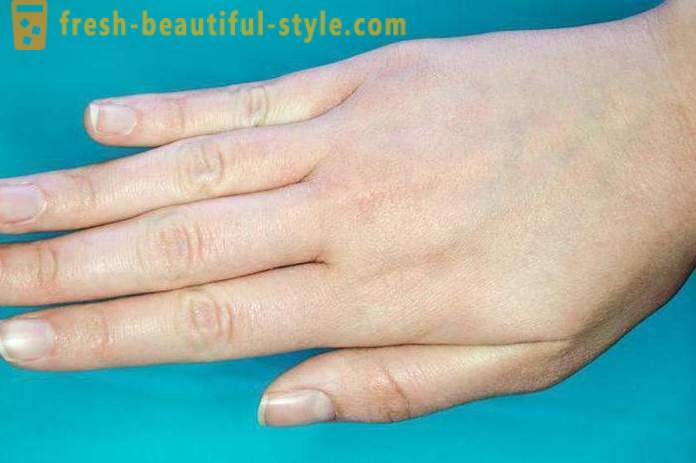 Φολιδωτό δέρμα στο πρόσωπο και τα χέρια: πιθανές αιτίες και τα χαρακτηριστικά της φροντίδας