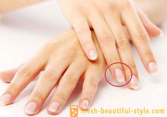 Λευκές κηλίδες στα νύχια των δακτύλων: τα αίτια και θεραπεία