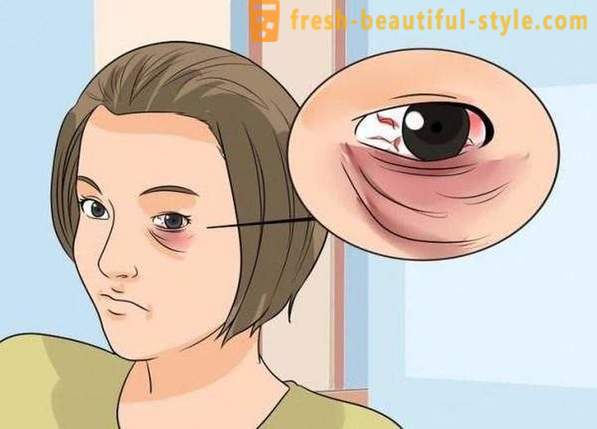 Πώς να καλύψει ένα μαύρο μάτι από χτύπημα: καλλυντικών, ειδικά συστάσεις και