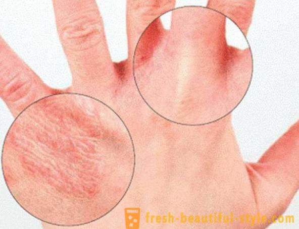 Ξηρό δέρμα των χεριών: Προκαλεί. Πολύ ξηρό δέρμα, τι να κάνω;