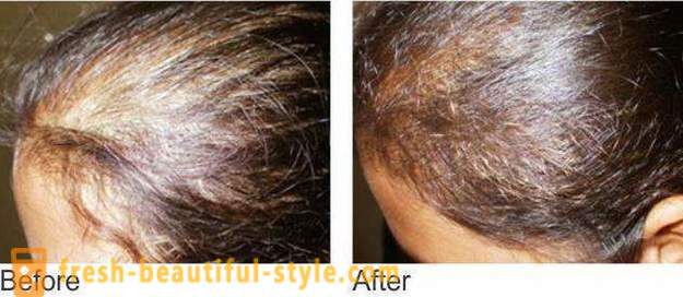 Μεσοθεραπεία για τα μαλλιά: εργαλεία μακιγιάζ και αντενδείξεις