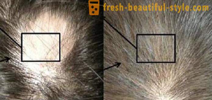 Μεσοθεραπεία για τα μαλλιά: εργαλεία μακιγιάζ και αντενδείξεις