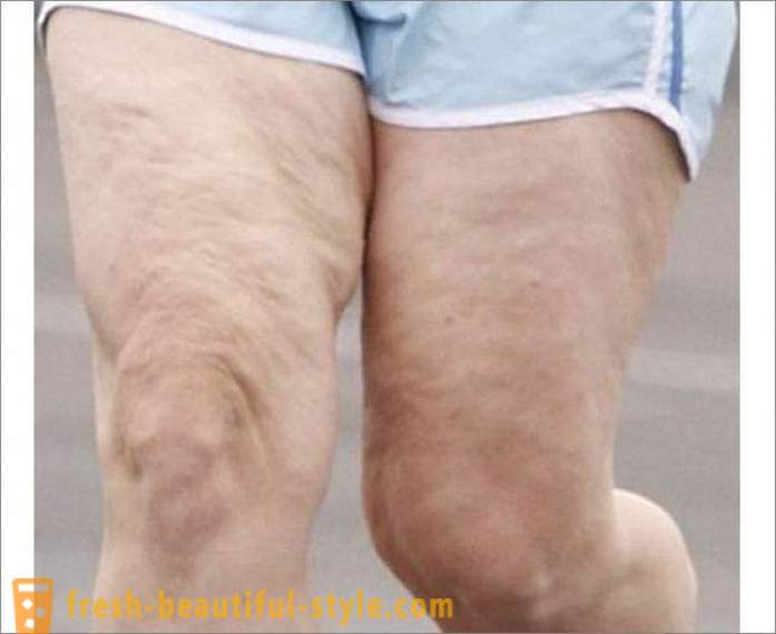 Πώς να απαλλαγείτε από την κυτταρίτιδα στα πόδια; Ασκήσεις για τα πόδια της κυτταρίτιδας